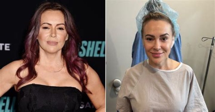 Alyssa Milano Plastic Surgery – Before And After Pics, Age And Net Worth 2023