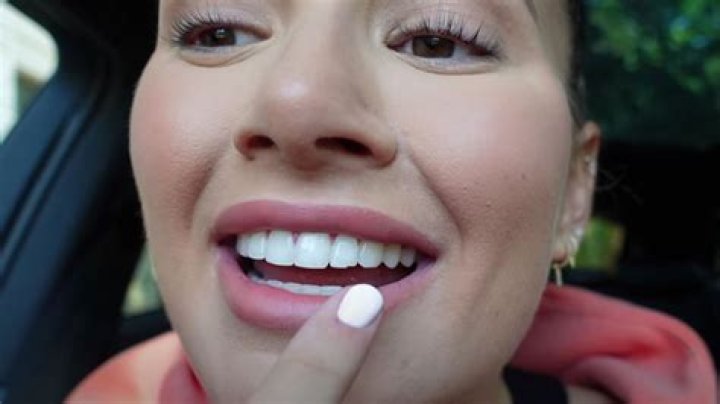 Devastated Molly Mae reveals her chipped real teeth after getting bonds removed