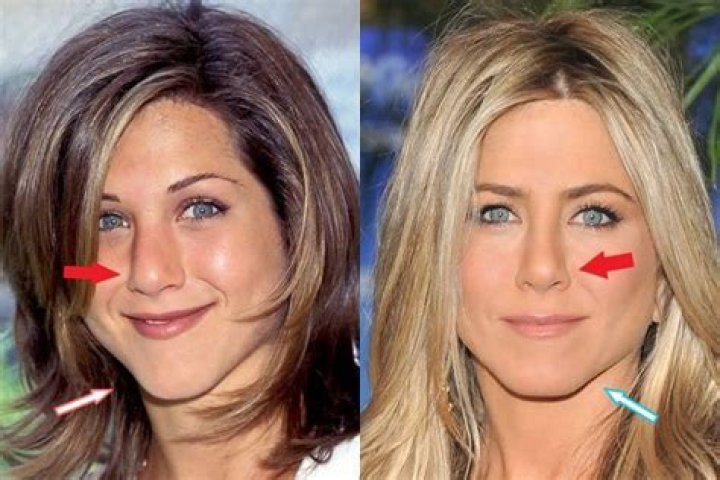 Did Jennifer Aniston Get A Plastic Surgery?
