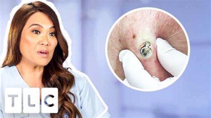 Dr Pimple Popper brings TLC to Instagram with oozing blackheads and whiteheads Thu 5 May 2022 1 ·