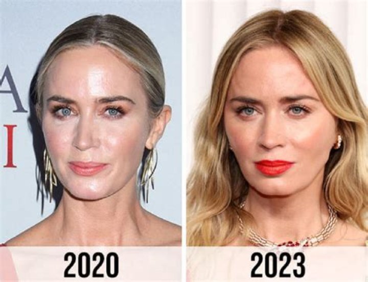 Emily Blunt Botox And Nose Job: Did She Underwent Surgery?