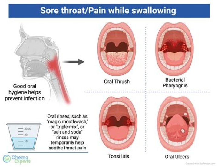 Exploring Sprite's Impact On Sore Throats