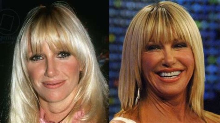 Know About Suzanne Somers Plastic Surgery With