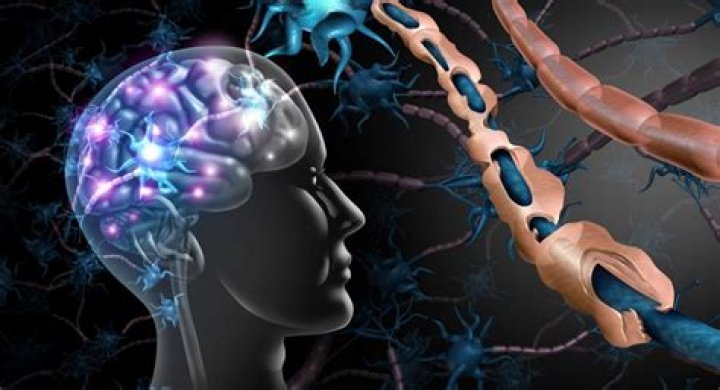 Unraveling The Enigma Of Multiple Sclerosis