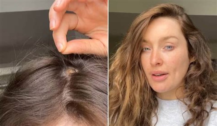 Why Is Felicia Bald On Big Brother? Alopecia Update 2023